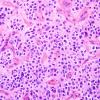 2B2 Ependymoma, clear cell (Case 2) H&E 4