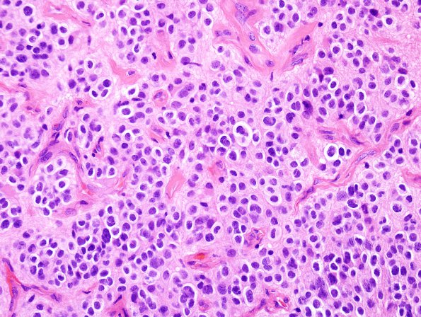 2B2 Ependymoma, clear cell (Case 2) H&E 4