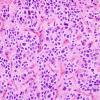 2B3 Ependymoma, clear cell (Case 2) H&E 5