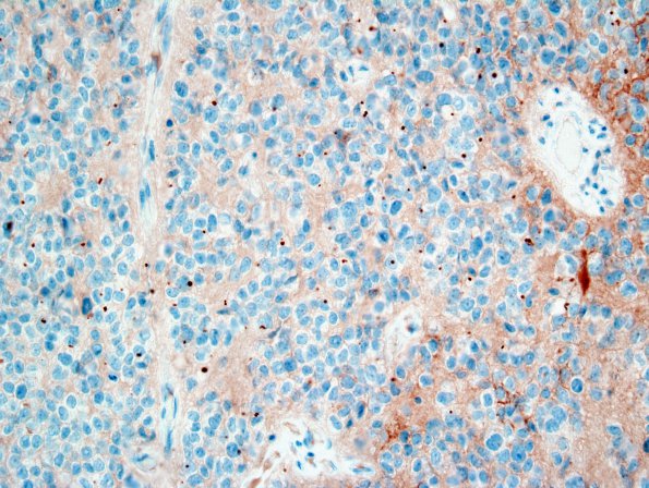 2C1 Ependymoma, clear cell type (Case 2) EMA 1.