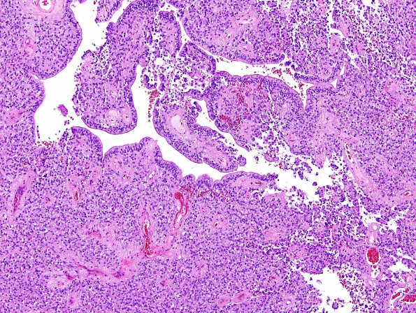 3A1 Ependymoma, clear cell areas (Case 3) H&E 15