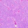 3A2 Ependymoma, clear cell areas (Case 3) H&E 9