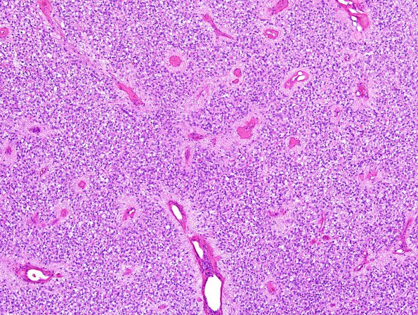 3A2 Ependymoma, clear cell areas (Case 3) H&E 9