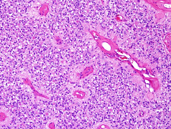 3A3 Ependymoma, clear cell areas (Case 3) H&E 2