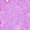 3A4 Ependymoma, clear cell areas (Case 3) H&E 6