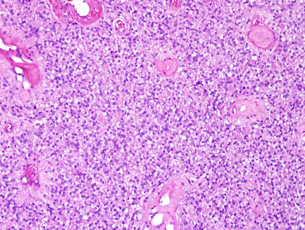 3A4 Ependymoma, clear cell areas (Case 3) H&E 6