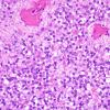 3A5 Ependymoma, clear cell areas (Case 3) H&E 5