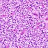 3A6 Ependymoma, clear cell areas (Case 3) H&E 10