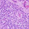 3A7 Ependymoma, clear cell areas (Case 3) H&E 1