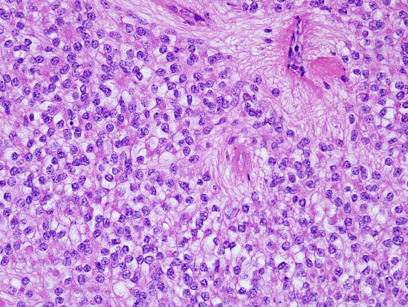 3A7 Ependymoma, clear cell areas (Case 3) H&E 1