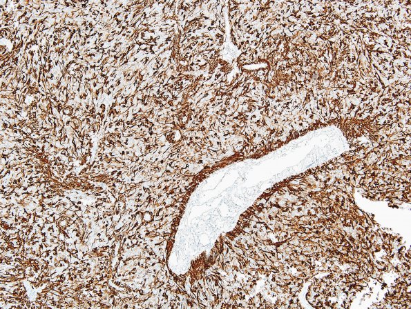 3B1 Ependymoma, clear cell (Case 3) GFAP 13