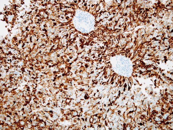 3B2 Ependymoma, clear cell (Case 3) GFAP 15