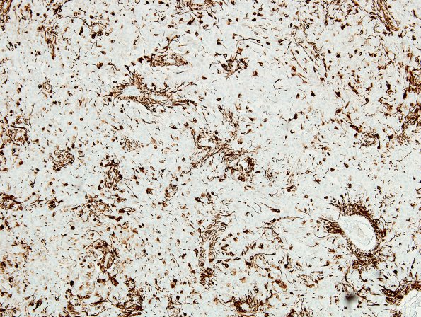 3B3 Ependymoma, clear cell (Case 3) GFAP 2