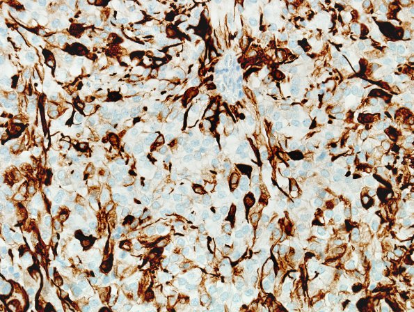 3B4 Ependymoma, clear cell (Case 3) GFAP 20