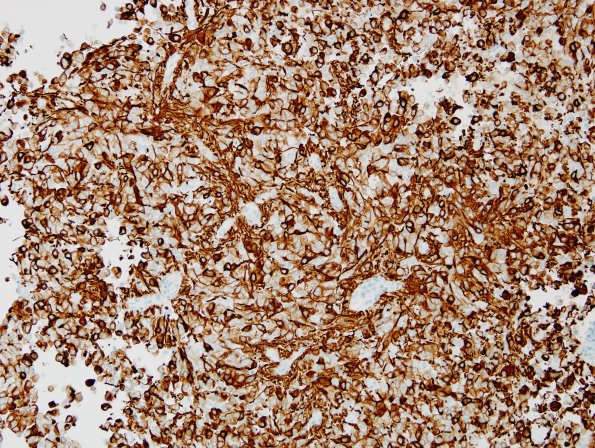 3B5 Ependymoma, clear cell (Case 3) GFAP solid area 2.