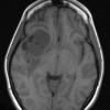 4A1 Ependymoma, extra-axial, clear and tanycytic (Case 4) T1 - Copy