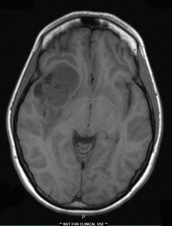 4A1 Ependymoma, extra-axial, clear and tanycytic (Case 4) T1 - Copy