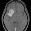 4A2 Ependymoma, extra-axial, clear and tanycytic (Case 4) T1 W - Copy