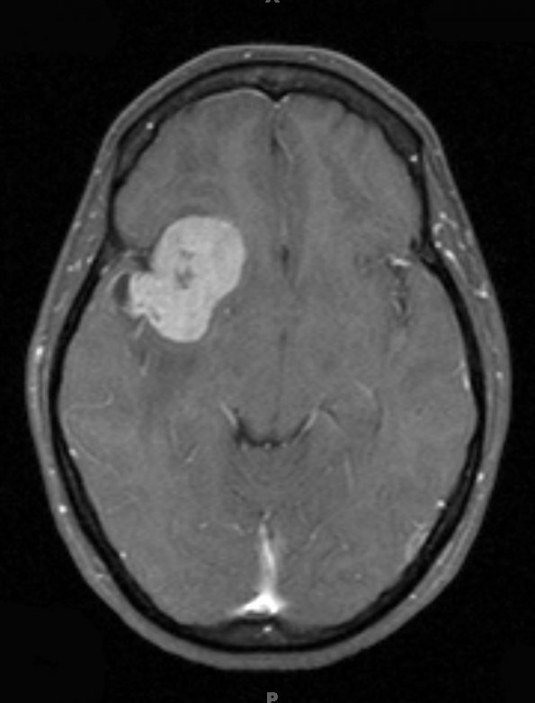 4A2 Ependymoma, extra-axial, clear and tanycytic (Case 4) T1 W - Copy