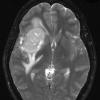 4A3 Ependymoma, extra-axial, clear and tanycytic (Case 4) T2 W - Copy