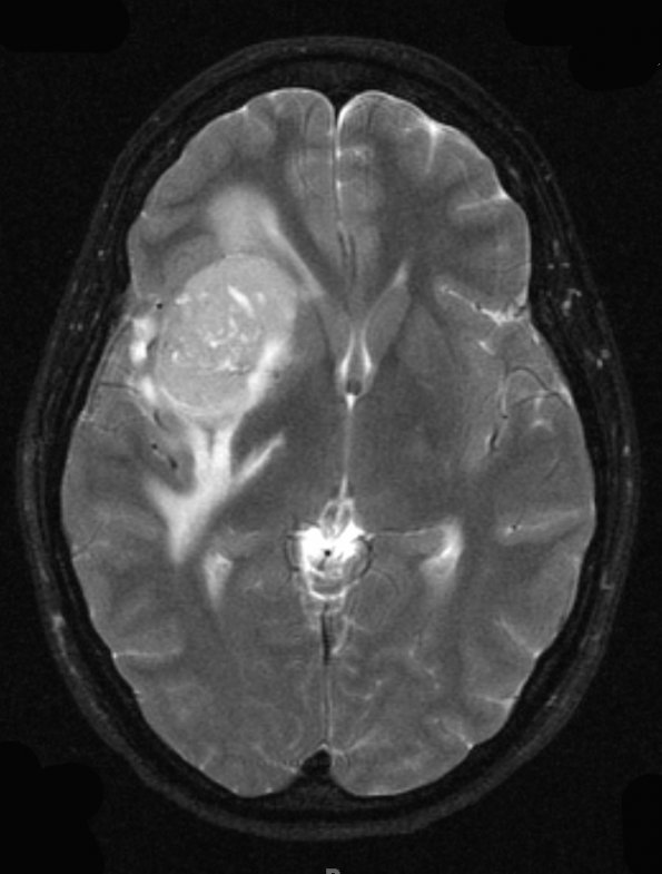 4A3 Ependymoma, extra-axial, clear and tanycytic (Case 4) T2 W - Copy