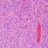 4B1 Ependymoma, extra-axia, clear & tanycyticl (Case 4) H&E 5