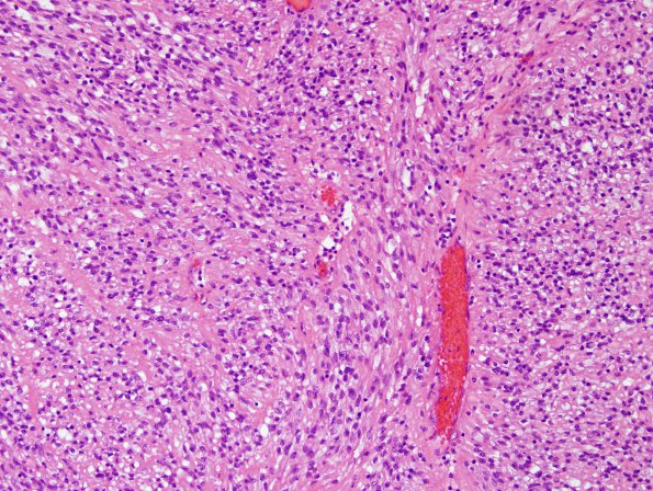 4B1 Ependymoma, extra-axia, clear & tanycyticl (Case 4) H&E 5