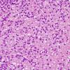 4B2 Ependymoma, clear cell area (Case 4) H&E 40X 2