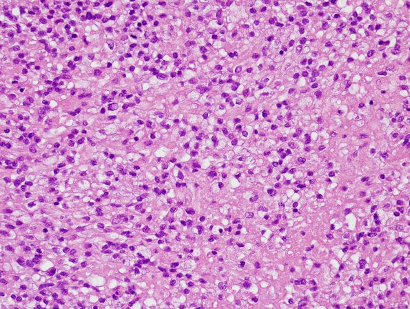 4B2 Ependymoma, clear cell area (Case 4) H&E 40X 2