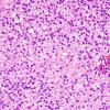 4B3 Ependymoma, clear cell area (Case 4) H&E 40X 3