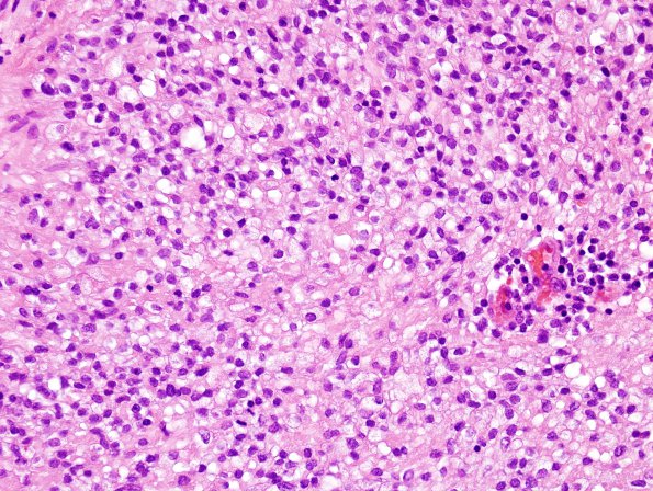 4B3 Ependymoma, clear cell area (Case 4) H&E 40X 3