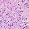 4B4 Ependymoma, extra-axia, clear & tanycyticl (Case 4) H&E 1