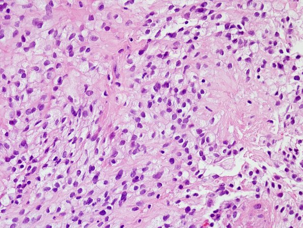 4B4 Ependymoma, extra-axia, clear & tanycyticl (Case 4) H&E 1