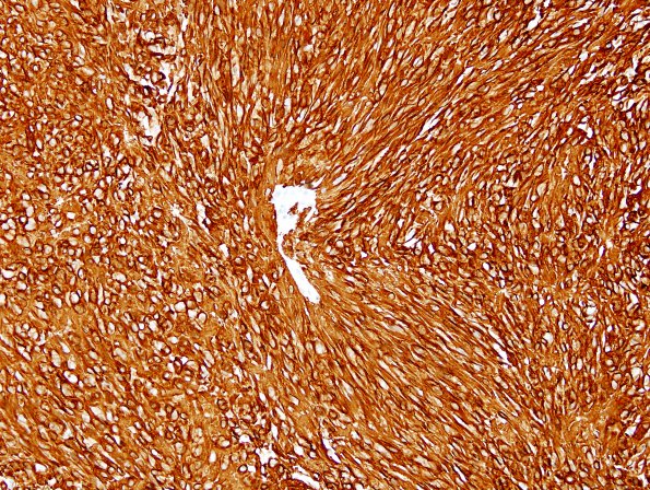 4C Ependymoma, classical perivascular pseudorosette (Case 4) GFAP 40X