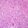 5A1 Ependymoma, clear cell (AANP 2005 Case 10B) H&E 4