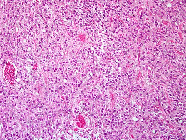 5A1 Ependymoma, clear cell (AANP 2005 Case 10B) H&E 4