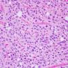 5A2 Ependymoma, clear cell (AANP 2005 Case 10) H&E 2