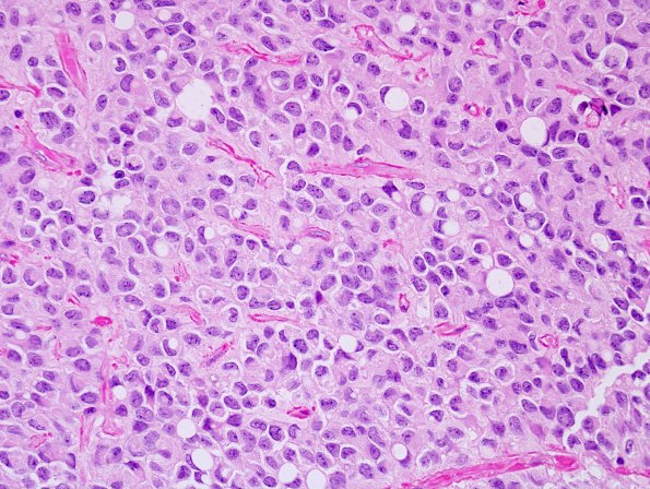 5A2 Ependymoma, clear cell (AANP 2005 Case 10) H&E 2