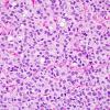 5A3 Ependymoma, clear cell (AANP 2005 Case 10) H&E 3