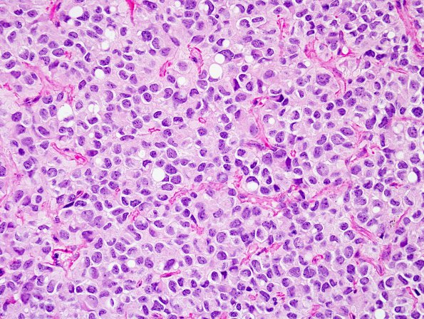 5A3 Ependymoma, clear cell (AANP 2005 Case 10) H&E 3