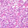 5A4 Ependymoma, clear cell (AANP 2005 Case 10B) H&E 2