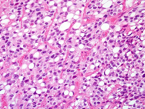 5A4 Ependymoma, clear cell (AANP 2005 Case 10B) H&E 2