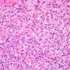 5A5 Ependymoma, clear cell (AANP 2005 Case 10B) H&E 3.