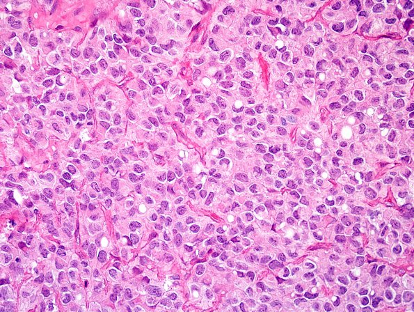 5A5 Ependymoma, clear cell (AANP 2005 Case 10B) H&E 3.