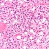 5A6 Ependymoma, clear cell (AANP 2005 Case 10B) H&E 40X