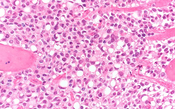 5A6 Ependymoma, clear cell (AANP 2005 Case 10B) H&E 40X