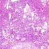 6B1 Ependymoma, mixed (clear cell) (Case 6) H&E 15