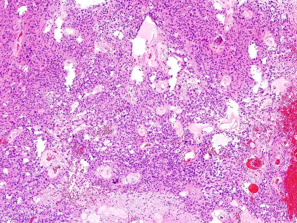 6B1 Ependymoma, mixed (clear cell) (Case 6) H&E 15