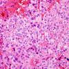 6B2 Ependymoma, mixed (clear cell) (Case 6) H&E 2