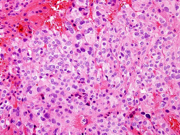 6B2 Ependymoma, mixed (clear cell) (Case 6) H&E 2